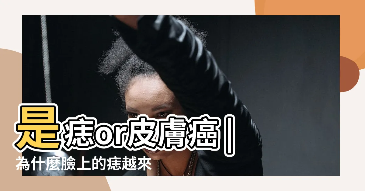 【身體長痣】是痣or皮膚癌 |為什麼臉上的痣越來越多 |長這2部位最危險 |