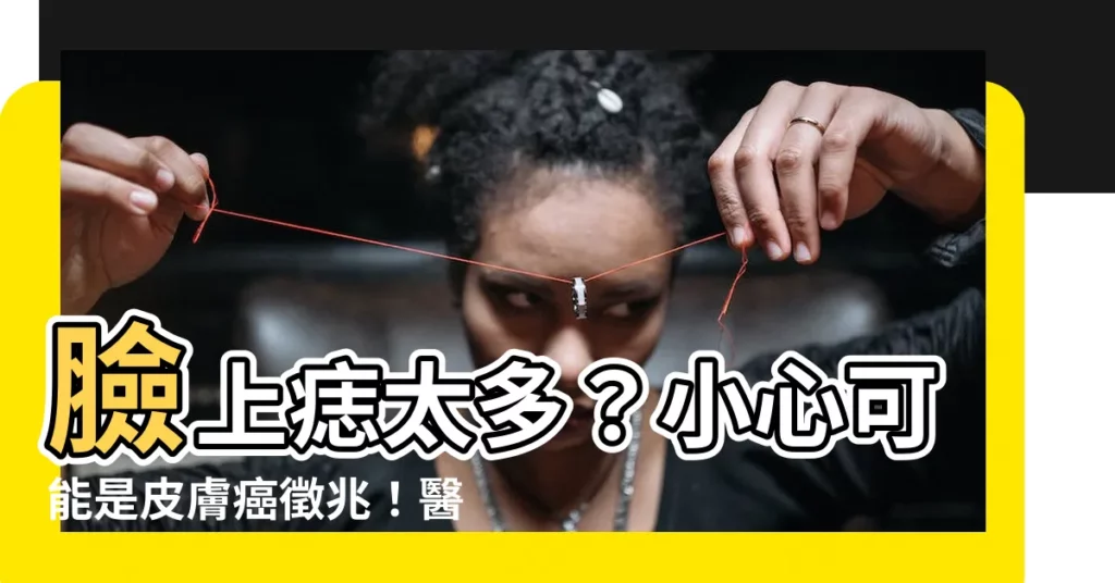 【痣太多】臉上痣太多？小心可能是皮膚癌徵兆！醫師破解痣的秘密