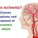 Accident vascular celebral – Ischemie