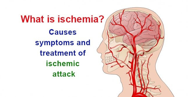 Accident vascular celebral – Ischemie
