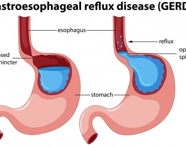 Exces de acid gastric sau Reflux-ul