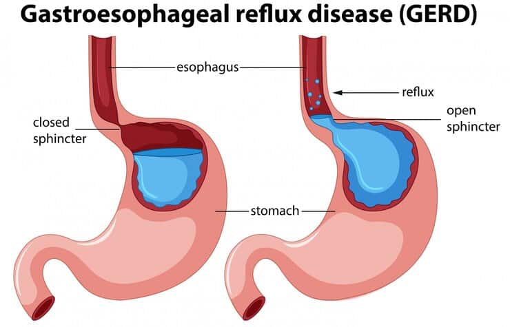 Exces de acid gastric sau Reflux-ul