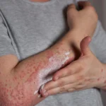 Eczema (Dermatita atopica)