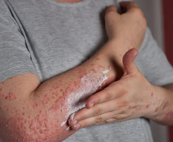 Eczema (Dermatita atopica)