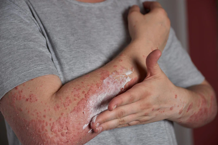 Eczema (Dermatita atopica)