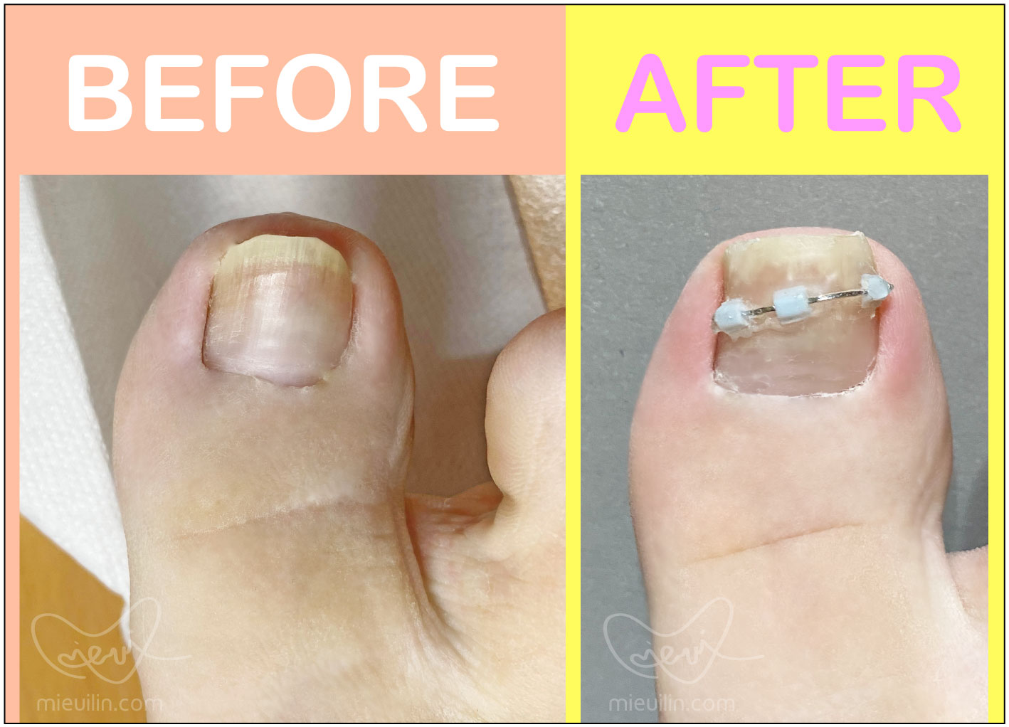 里特指甲矯正器費用