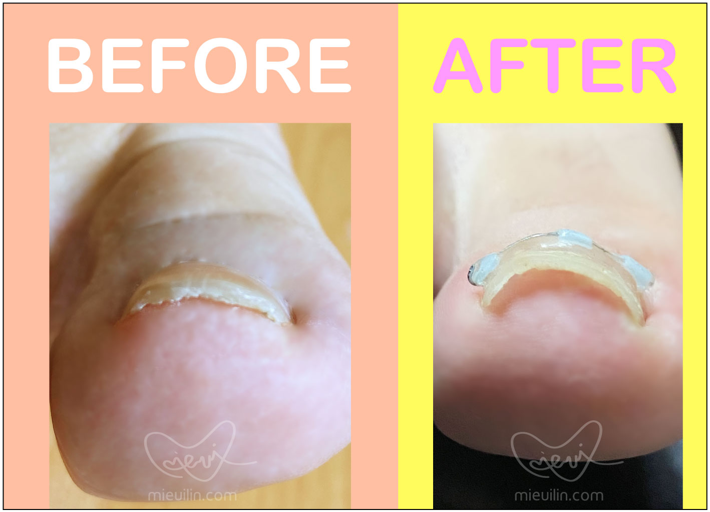 里特指甲矯正器