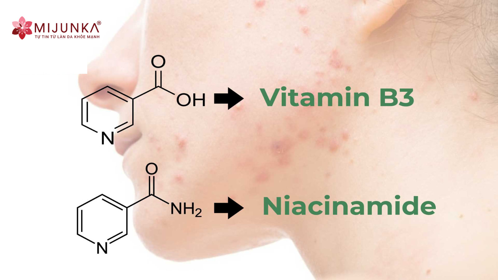 Tác dụng kháng viêm, điều trị mụn của niacinamide