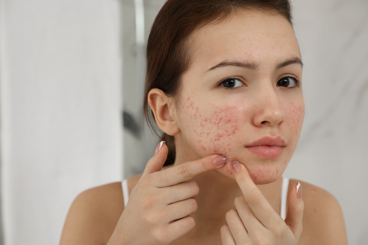 Cách Trị Mụn Li Ti