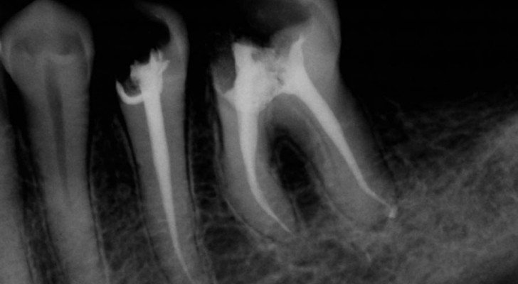 How A Root Canal Could Be Making You Sick