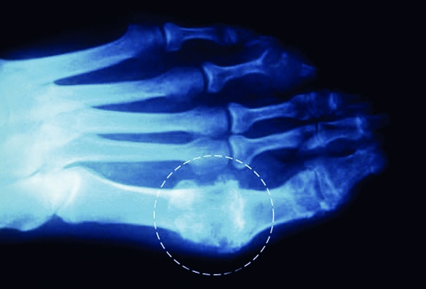 How To Rid Your Joints Of Uric Acid Crystals (Gout & Joint Pain)