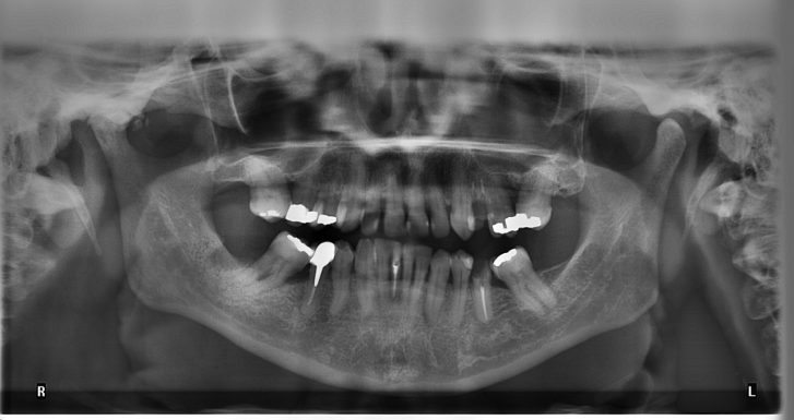 Dental Amalgam Fillings Release MORE Mercury When Combined With WiFi Exposure