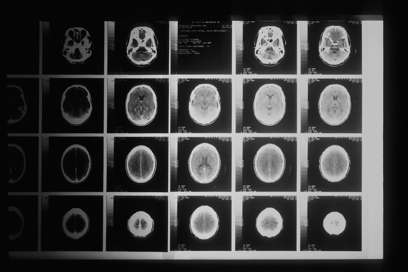 An X-ray of the head taken by CAT scan. Multiple rows of the scan show the head and brain at various stages of the imaging process.