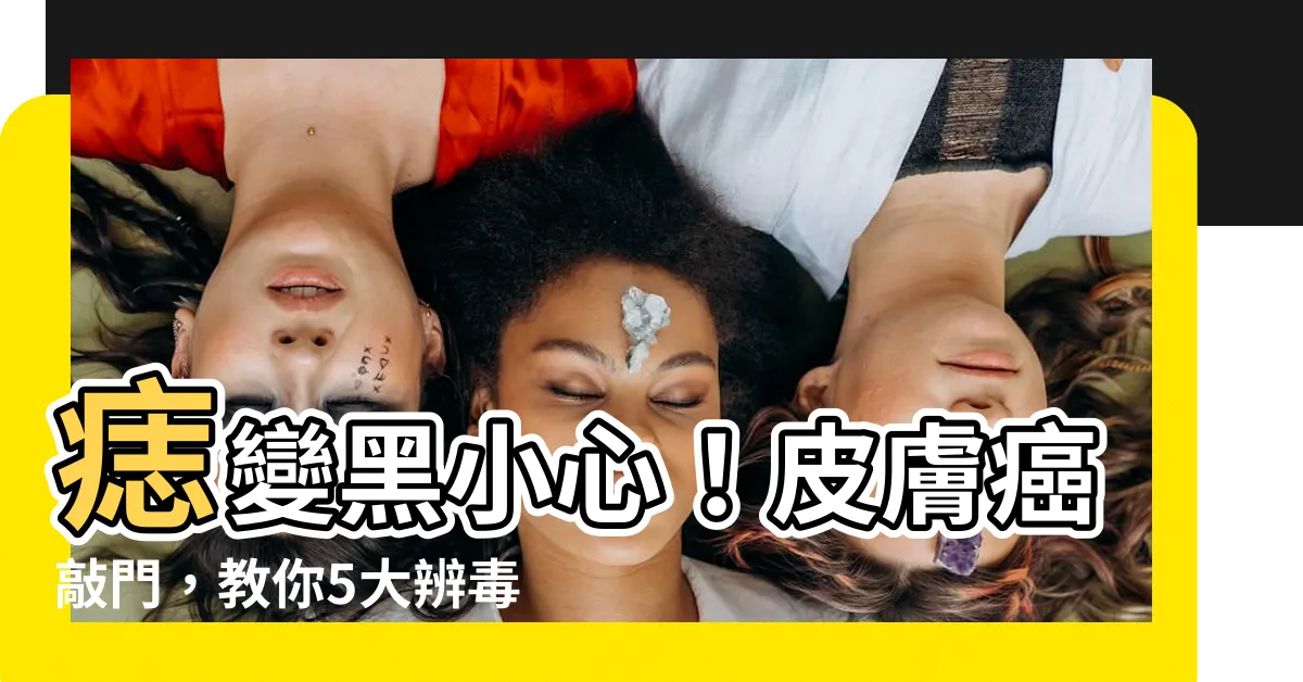【痣很黑】痣變黑小心！皮膚癌敲門，教你5大辨毒痣特徵