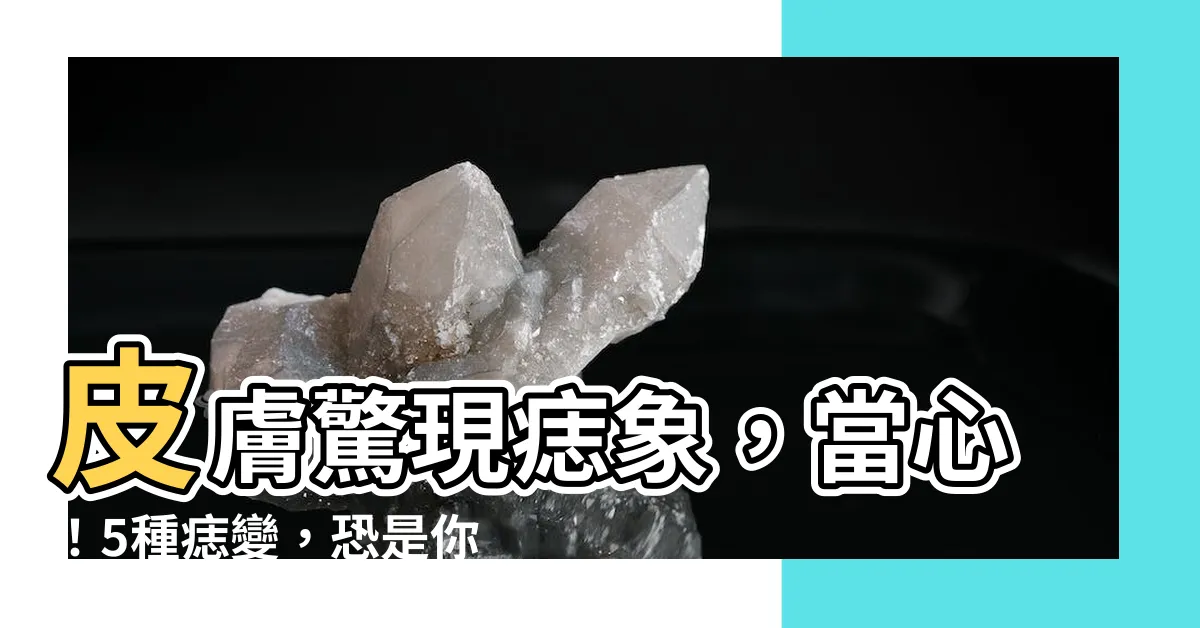 【長出痣】皮膚驚現痣象，當心！5種痣變，恐是你身體發出求救信號