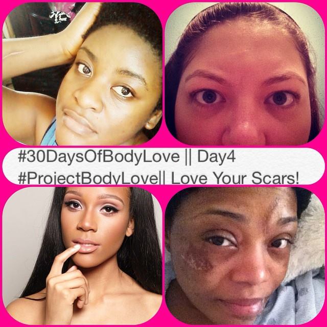 #ProjectBodyLove Day 4 of 30! Healing Our Wounds and Scars 