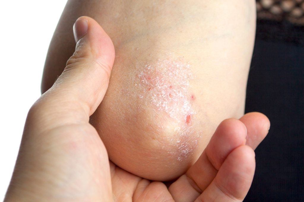 5786589b psoriasis