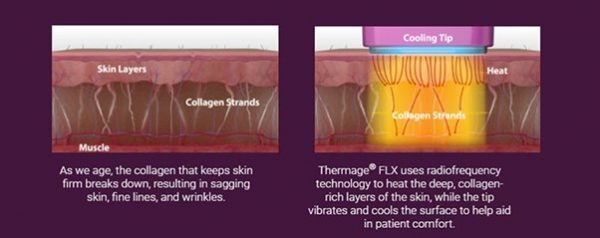 การทำงานของ Thermage ลงลึกถึงชั้นไขมัน 