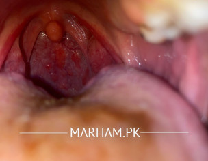 Red Spots In Throat 