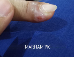 Finger Problem