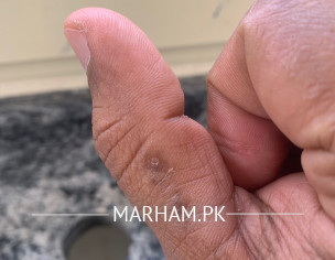 Finger Skin 