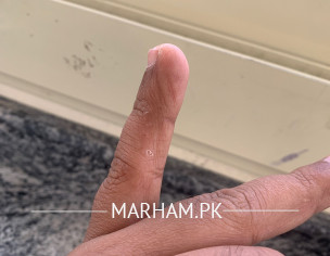 Finger Skin 