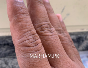 Finger Skin 