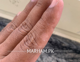 Finger Skin 