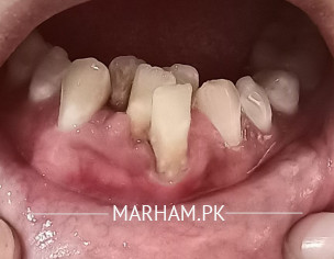 Crowded Teeth,