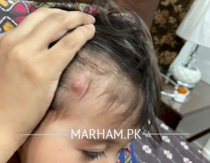 Pimple On Head