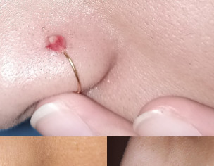 Skin Problem