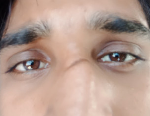 Cut Mark On Nose