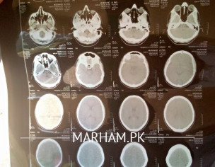Brain Problem