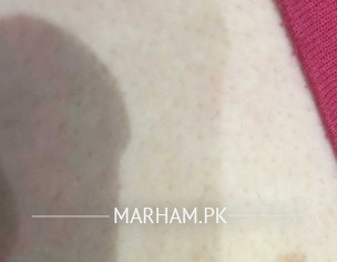 Breast Mark