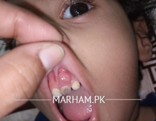 Teething Issue