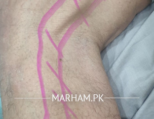 Leg Pain While Walking.