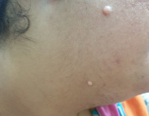 White Pimple