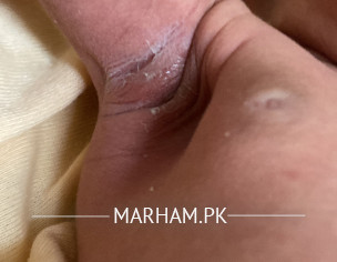 Armpit Infection 