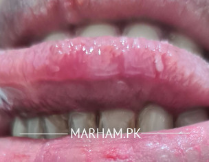 Tounge Bite