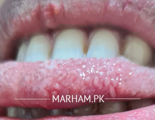 Tounge Bite