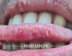 Tounge Bite