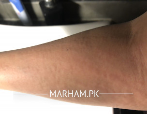 Urticaria At Night 