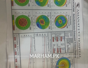 Keratoconus 