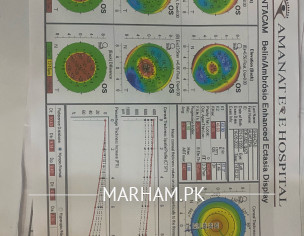 Keratoconus 