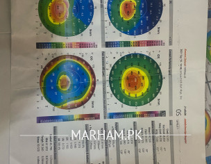 Keratoconus 