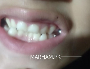 Teeth Alignment