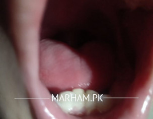 Teeth Alignment