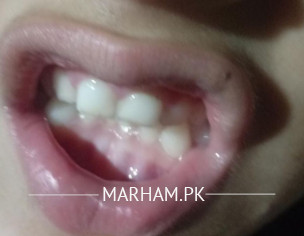 Teeth Alignment