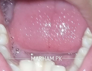 Teeth Alignment