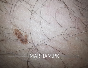 Normal Mole?